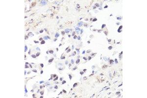 Immunohistochemistry of paraffin-embedded human lung cancer using P-MYC-T58 antibody (ABIN3019538, ABIN3019539, ABIN3019540 and ABIN6225454) at dilution of 1:100 (40x lens). (c-MYC antibody  (pThr58))
