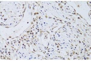 Immunohistochemistry of paraffin-embedded Human gastric cancer using FKBP4 Polyclonal Antibody at dilution of 1:100 (40x lens). (FKBP4 antibody)