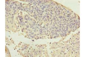Immunohistochemistry of paraffin-embedded human cervical cancer using ABIN7144611 at dilution of 1:100
