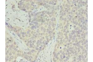 Immunohistochemistry of paraffin-embedded human gastric cancer using ABIN7142542 at dilution of 1:100 (RPS28 antibody  (AA 1-69))