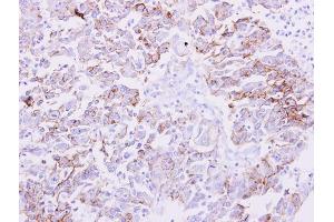 IHC-P Image NDRG1 antibody detects NDRG1 protein at membrane on human liver carcinoma by immunohistochemical analysis. (NDRG1 antibody)