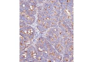 Immunohistochemical analysis of (ABIN387989 and ABIN2845007) on paraffin-embedded Human colon carcinoma tissue was performed on the Leica®BOND RXm. (IFITM3 antibody  (N-Term))
