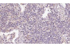 ABIN6273155 at 1/100 staining Human lymph cancer tissue by IHC-P. (RND3 antibody  (Internal Region))