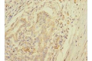 Immunohistochemistry of paraffin-embedded human pancreatic cancer using ABIN7157671 at dilution of 1:100 (SPC25 antibody  (AA 1-224))