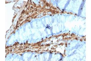 Formalin-fixed, paraffin-embedded human Colon Carcinoma stained with Annexin A1 Mouse Monoclonal Antibody (CPTC-ANXA1-1). (Annexin a1 antibody)