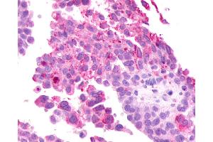 Anti-GRM2 / MGLUR2 antibody IHC of human Ovary, Carcinoma. (GRM2 antibody  (N-Term))