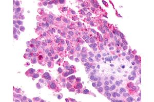 Anti-GRM2 / MGLUR2 antibody IHC of human Ovary, Carcinoma.