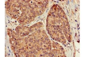 Immunohistochemistry of paraffin-embedded human ovarian cancer using ABIN7154745 at dilution of 1:100 (GNB5 antibody  (AA 1-353))