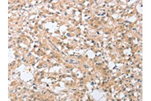 The image on the left is immunohistochemistry of paraffin-embedded Human thyroid cancer tissue using ABIN7131059(SIGLEC9 Antibody) at dilution 1/30, on the right is treated with fusion protein. (SIGLEC9 antibody)