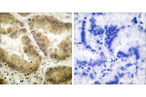 Peptide - +Immunohistochemical analysis of paraffin-embedded human lung carcinoma tissue using HDAC7 antibody (#C0227).