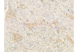 ABIN6258999 and ABIN6276112 at 1/100 staining human tongue carcinoma by IHC-P.