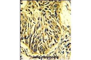 Formalin-fixed and paraffin-embedded human lung carcinoma with C Antibody (Center), which was peroxidase-conjugated to the secondary antibody, followed by DAB staining. (PROCR antibody  (AA 104-132))