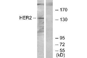Immunohistochemistry analysis of paraffin-embedded human breast carcinoma tissue using HER2 antibody. (ErbB2/Her2 antibody)
