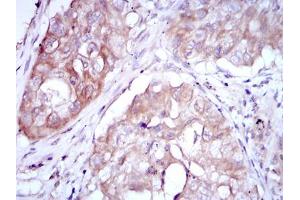 Immunohistochemical analysis of paraffin-embedded lung cancer using MTHFR mouse mAb with DAB staining.
