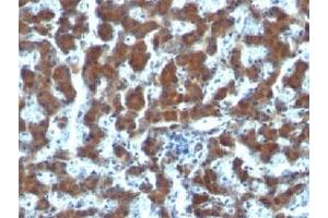 IHC testing of FFPE human hepatocellular carcinoma and RBP antibody (clone G4E4). (RBP1 antibody  (AA 74-182))