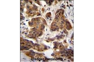 C4orf21 Antibody (N-term) (ABIN655214 and ABIN2850480) immunohistochemistry analysis in formalin fixed and paraffin embedded human bladder carcinoma followed by peroxidase conjugation of the secondary antibody and DAB staining.