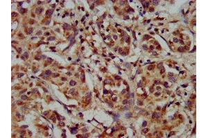 IHC image of ABIN7142850 diluted at 1:300 and staining in paraffin-embedded human liver cancer performed on a Leica BondTM system. (CYP8B1 antibody  (AA 303-440))