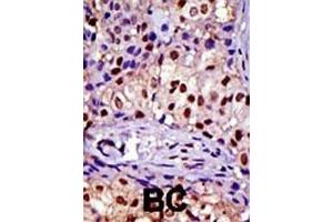 Formalin-fixed and paraffin-embedded human cancer tissue reacted with the primary antibody, which was peroxidase-conjugated to the secondary antibody, followed by DAB staining. (RAD23A antibody  (C-Term))