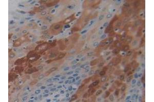 IHC-P analysis of Human Stomach Cancer Tissue, with DAB staining. (PD-1 antibody  (AA 41-132))