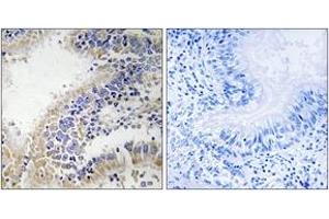 Immunohistochemistry analysis of paraffin-embedded human breast carcinoma tissue, using DHODH Antibody. (DHODH antibody  (AA 211-260))