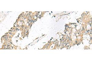 Immunohistochemistry of paraffin-embedded Human colorectal cancer tissue using MGAT4B Polyclonal Antibody at dilution of 1:50(x200) (MGAT4B antibody)