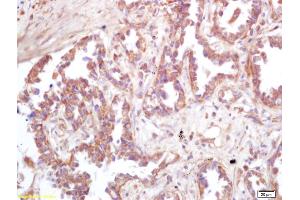 Formalin-fixed and paraffin embedded human lung carcinoma labeled with Rabbit Anti ATP6IP2 Polyclonal Antibody, Unconjugated (ABIN872738) at 1:200 followed by conjugation to the secondary antibody and DAB staining (ATP6AP2 antibody  (AA 280-350))