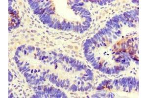 Immunohistochemistry of paraffin-embedded human ovarian cancer using ABIN7147403 at dilution of 1:100 (CEP29 (AA 86-156) antibody)