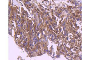 Paraformaldehyde-fixed, paraffin embedded human breast carcinoma, Antigen retrieval by boiling in sodium citrate buffer (pH6) for 15min, Block endogenous peroxidase by 3% hydrogen peroxide for 30 minutes, Blocking buffer (normal serum) at 37°C for 20min, Antibody incubation with IRF3 (4C3) Monoclonal Antibody  at 1:50 overnight at 4°C, followed by a conjugated secondary and DAB staining. (IRF3 antibody)