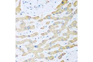 Immunohistochemistry of paraffin-embedded human liver cancer using FDXR antibody. (Ferredoxin Reductase antibody  (AA 252-491))