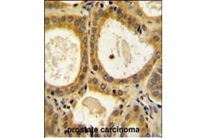 CTLA4 Antibody (N-term) (ABIN654422 and ABIN2844157) immunohistochemistry analysis in formalin fixed and paraffin embedded human prostate carcinoma followed by peroxidase conjugation of the secondary antibody and DAB staining.