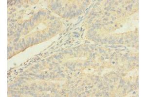 Immunohistochemistry of paraffin-embedded human endometrial cancer using ABIN7173241 at dilution of 1:100