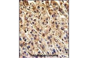 Formalin-fixed and paraffin-embedded human hepatocarcinoma reacted with SHP2 Antibody , which was peroxidase-conjugated to the secondary antibody, followed by DAB staining. (PTPN11 antibody  (AA 526-551))