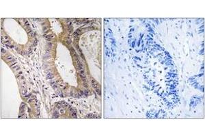Immunohistochemistry analysis of paraffin-embedded human colon carcinoma tissue, using STK24 Antibody. (STK24 antibody  (AA 319-368))