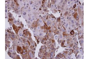 IHC-P Image Immunohistochemical analysis of paraffin-embedded human adrenal gland tumor, using UBE2T, antibody at 1:100 dilution. (Ube2t antibody  (C-Term))