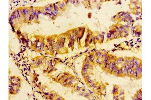 Immunohistochemistry of paraffin-embedded human endometrial cancer using ABIN7174438 at dilution of 1:100 (UBE2D2 antibody  (AA 1-147))