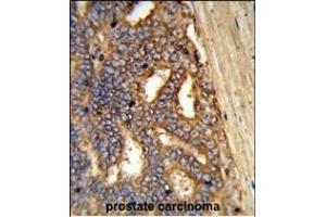 Formalin-fixed and paraffin-embedded human prostate carcinoma reacted with Y1A Antibody (Center), which was peroxidase-conjugated to the secondary antibody, followed by DAB staining. (AMY1A antibody  (AA 195-223))