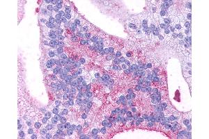 Anti-GPR88 antibody IHC of human Prostate, Carcinoma. (GPR88 antibody  (C-Term))