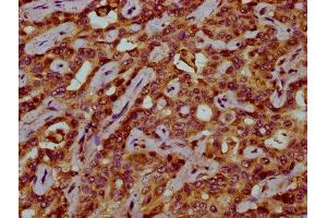 IHC image of ABIN7175529 diluted at 1:200 and staining in paraffin-embedded human liver cancer performed on a Leica BondTM system. (VKORC1 antibody  (AA 30-74))