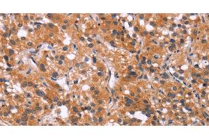 Immunohistochemistry of paraffin-embedded Human thyroid cancer using MAPK11 Polyclonal Antibody at dilution of 1:30 (MAPK11 antibody)