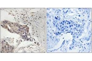 Immunohistochemistry analysis of paraffin-embedded human breast carcinoma tissue, using SLP-76 (Ab-128) Antibody. (LCP2 antibody  (AA 94-143))