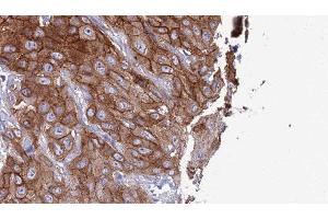 ABIN6277320 at 1/100 staining Human Head and neck cancer tissue by IHC-P. (CLEC4A antibody  (C-Term))