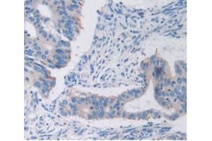 Detection of TFR in Human Rectum Cancer Tissue using Anti-Transferrin Receptor (TFR) Polyclonal Antibody (Transferrin Receptor antibody  (AA 567-744))