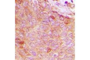 Immunohistochemical analysis of Copine 8 staining in human breast cancer formalin fixed paraffin embedded tissue section.
