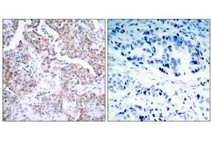 Immunohistochemical analysis of paraffin-embedded human breast carcinoma tissue using p53 (phospho- Ser15) antibody (E011094). (p53 antibody  (pSer15))