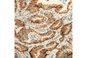 Immunohistochemical analysis of PEX11B staining in human colon cancer formalin fixed paraffin embedded tissue section. (PEX11B antibody  (Center))