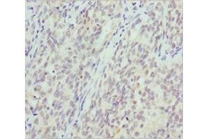 Immunohistochemistry of paraffin-embedded human lung cancer using ABIN7145471 at dilution of 1:100