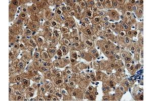 Immunohistochemical staining of paraffin-embedded Adenocarcinoma of Human endometrium tissue using anti-QPRT mouse monoclonal antibody. (QPRT antibody)