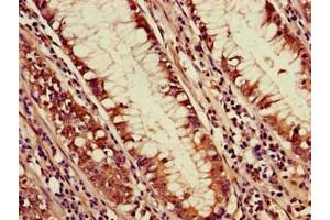 Immunohistochemistry of paraffin-embedded human colon cancer using ABIN7169756 at dilution of 1:100