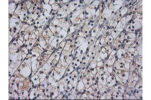 Immunohistochemical staining of paraffin-embedded Carcinoma of Human kidney tissue using anti-RASSF1 mouse monoclonal antibody. (RASSF1 antibody)