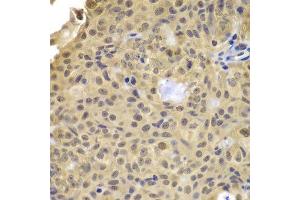 Immunohistochemistry of paraffin-embedded human well-differentiated squamous skin carcinoma using CCNA2 antibody. (Cyclin A antibody)